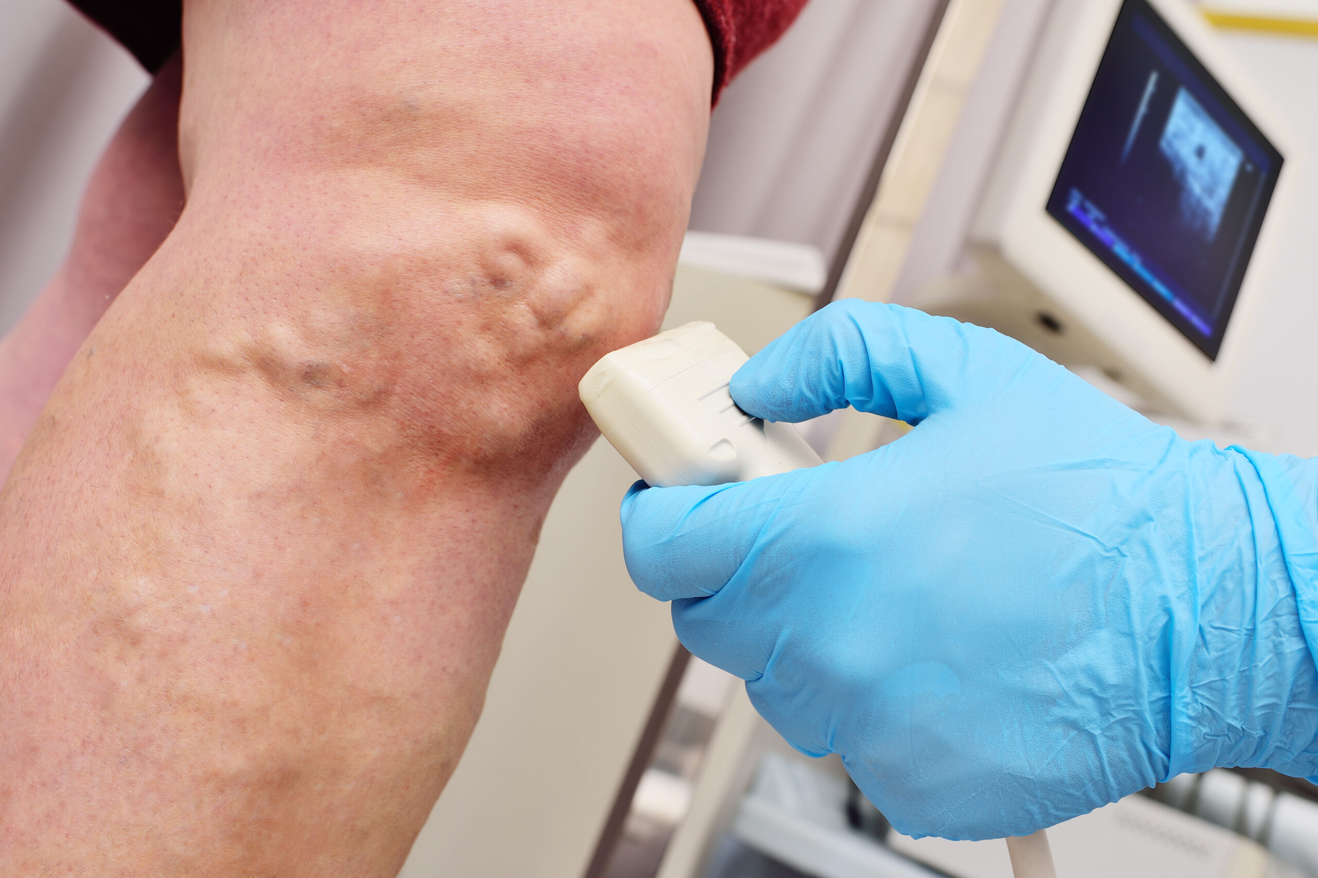 An interventional radiologist performs an ultrasound examination of a patient's varicose veins